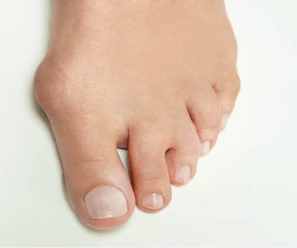 bunions sydney